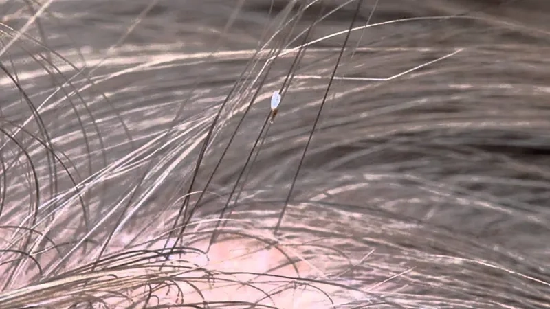 Vòng đời con chấy từ trứng đến trưởng thành