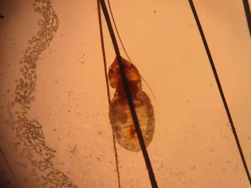 Trứng chấy dưới kính phóng đại