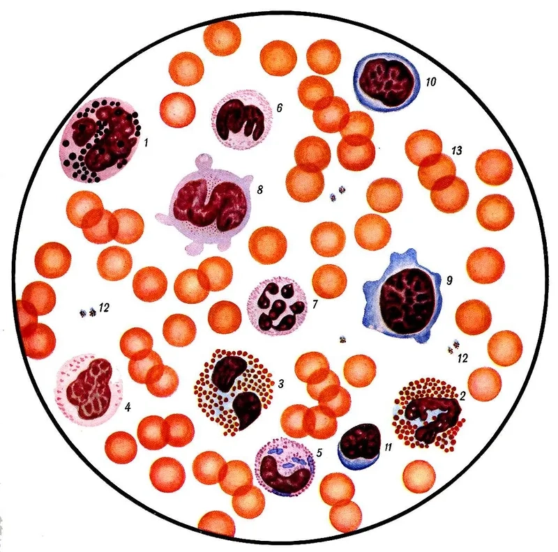 Tế bào máu thiếu máu với hồng cầu nhỏ