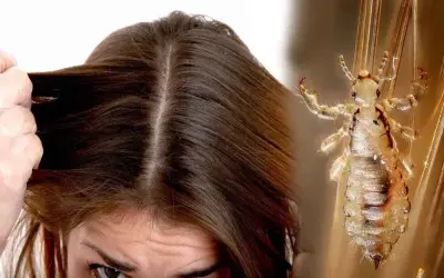 Khám phá con chấy soi kính - Sinh vật ký sinh trên da đầu