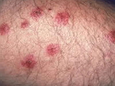 Trứng côn trùng: Mối nguy hại tiềm ẩn và cách xử lý hiệu quả